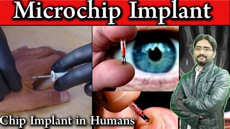 rfid chip implant for disabled|Microchip implant (human) .